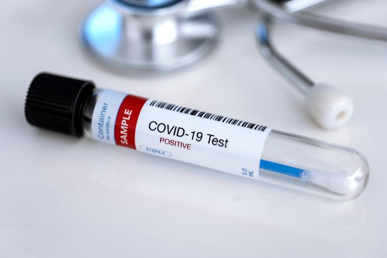 COVID-19-positive test