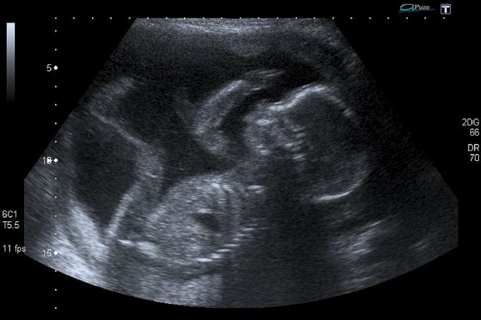 Only 37% of Americans Identify As Pro-Life, but 67% Want Limits On Abortion| National Catholic Register