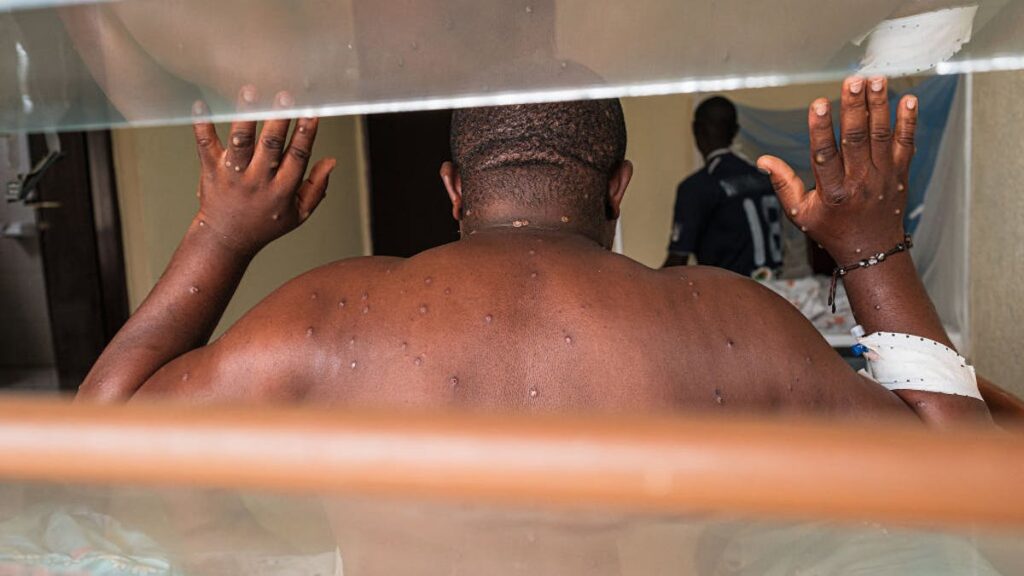 Leftist Scientists Caught Sneaking 113 Vials Of Monkeypox Into America