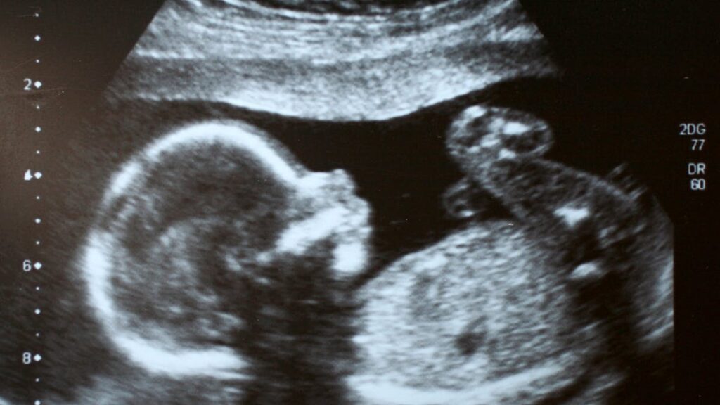 YouTube Star Ends Life Of Unborn Child After Down Syndrome Diagnosis